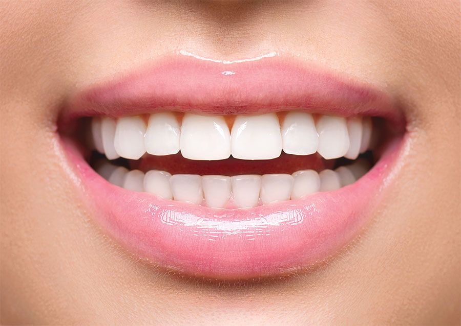 Tratamiento - Blanqueamiento Dental - BFEsteticaDental
