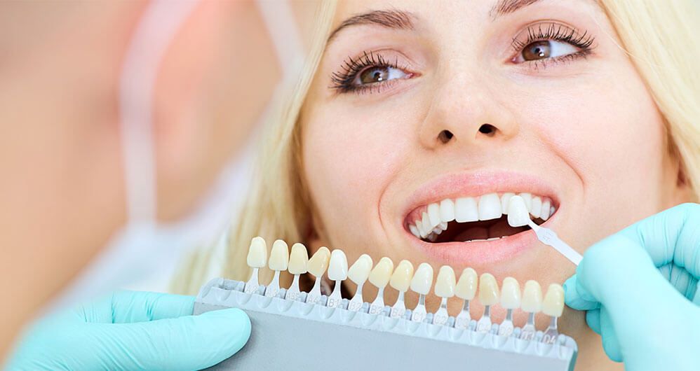 Estética - Blanqueamiento Dental - BFEsteticaDental