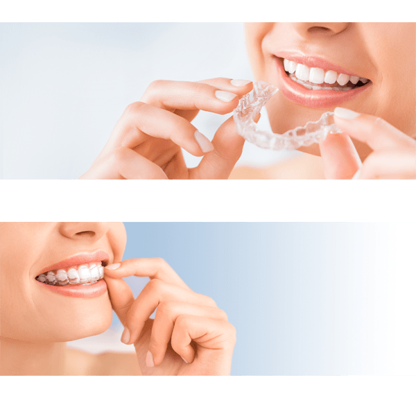 Ortodoncia estética - Invisalign - BFEstéticaDental