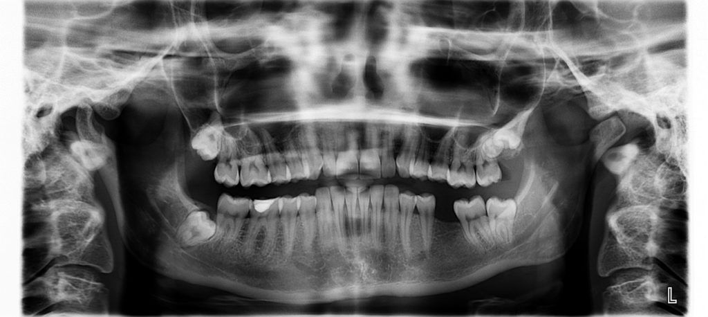 edentulismo-odontología-BFEsteticadental