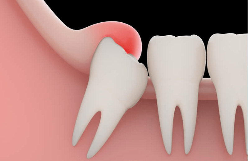 Diente retenido - BFEsteticaDental - Destacada - 1.jpg