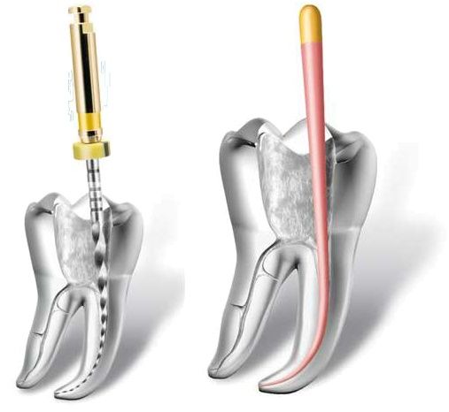 Endodoncia - Fracturas dentales - BFEstéticaDental