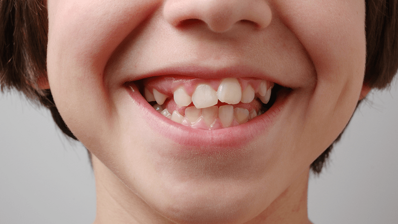 Chuparse el dedo - Niños - BFEstéticaDental