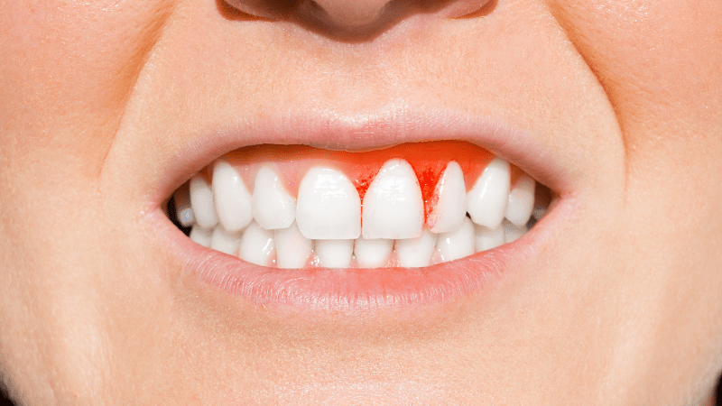 Retracción de encías - Encías recidivas - BFEstéticaDental