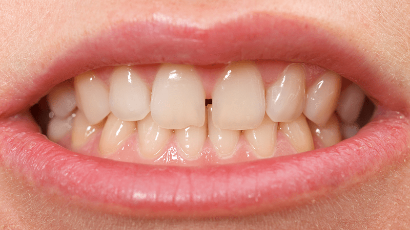 Diastemas - incisivos superiores - BFEstéticaDental