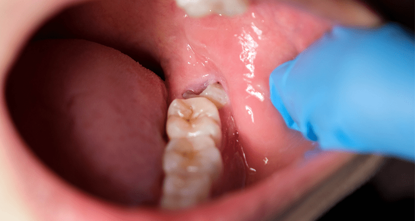 Cordales - Recomendaciones a seguir para operarse las muelas del juicio - BFEstéticaDental