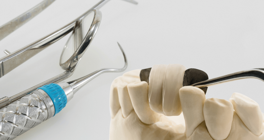 Prótesis Maryland - puente dental - BFEstéticaDental