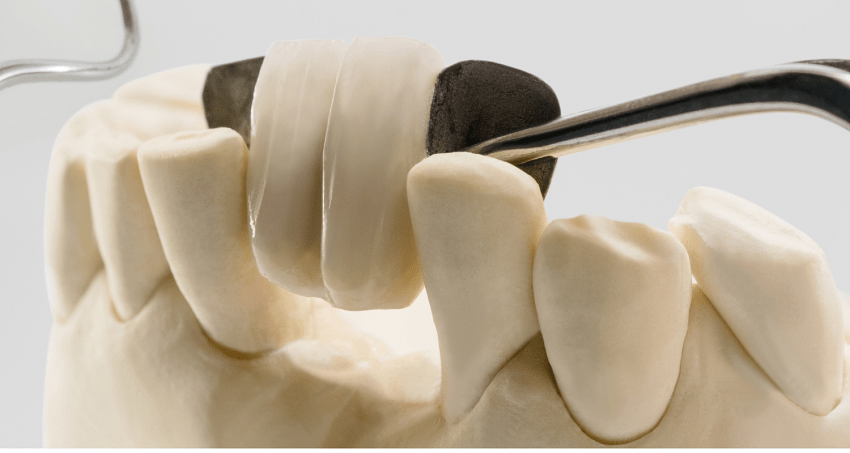 Puente Maryland - prótesis dental - BFEstéticaDental