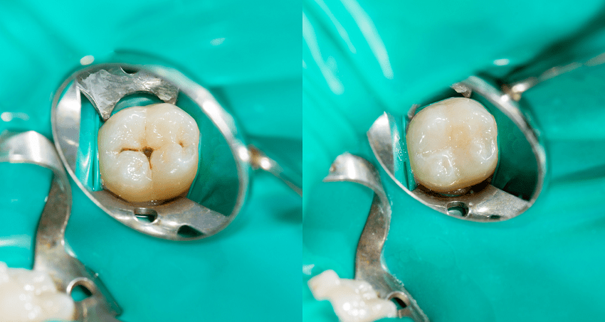 Pulpotomía - odontopediatría - BFEsteticaDental