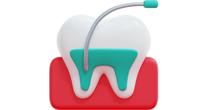 Pulpotomía - pulpectomía - BFEstéticaDental