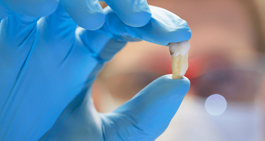 Exodoncia - Tecnica odontológica - BFEstéticaDental