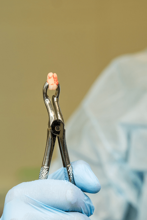 Exodoncia - odontología general - BFEstéticaDental