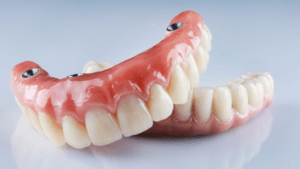 Prótesis dentales - Híbridas - BFEstéticaDental