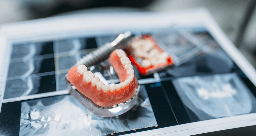 Dispositivos artíficiales - Secundaria - BFEstéticaDental