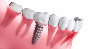 Prótesis dentales - fijas - BFEstéticaDental