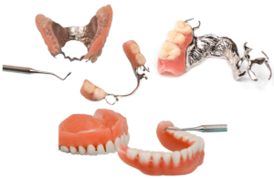 Prótesis dentales - removibles - BFEstéticaDental 1