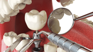 Prótesis dentales - sobre implantes - BFEstéticaDental