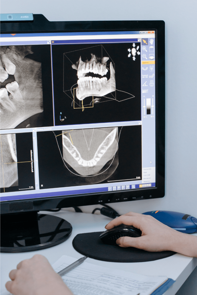 Radiología bucodental 4 - Tomografía computarizada - BFEstéticaDental
