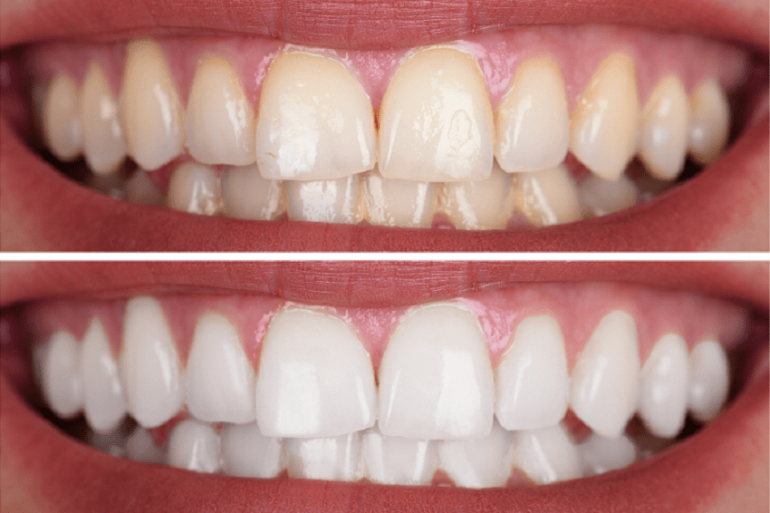 Tratamientos de blanqueamiento dental - LED y Láser - BFEstéticaDental