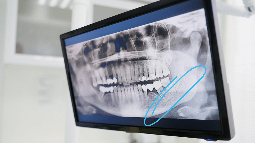 Nervio dentario inferior - NAI - BFEstéticaDental