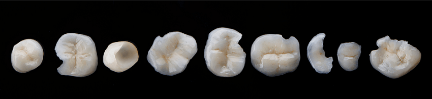 Incrustaciones dentales - Materiales - BFEstéticaDental