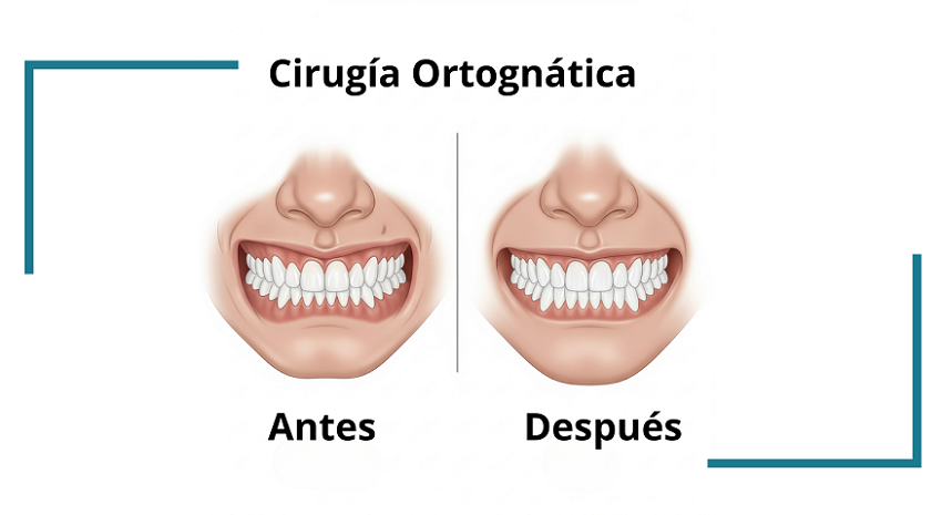 Cirugía ortognática - Antes y Después - destacada - BFEstéticaDental