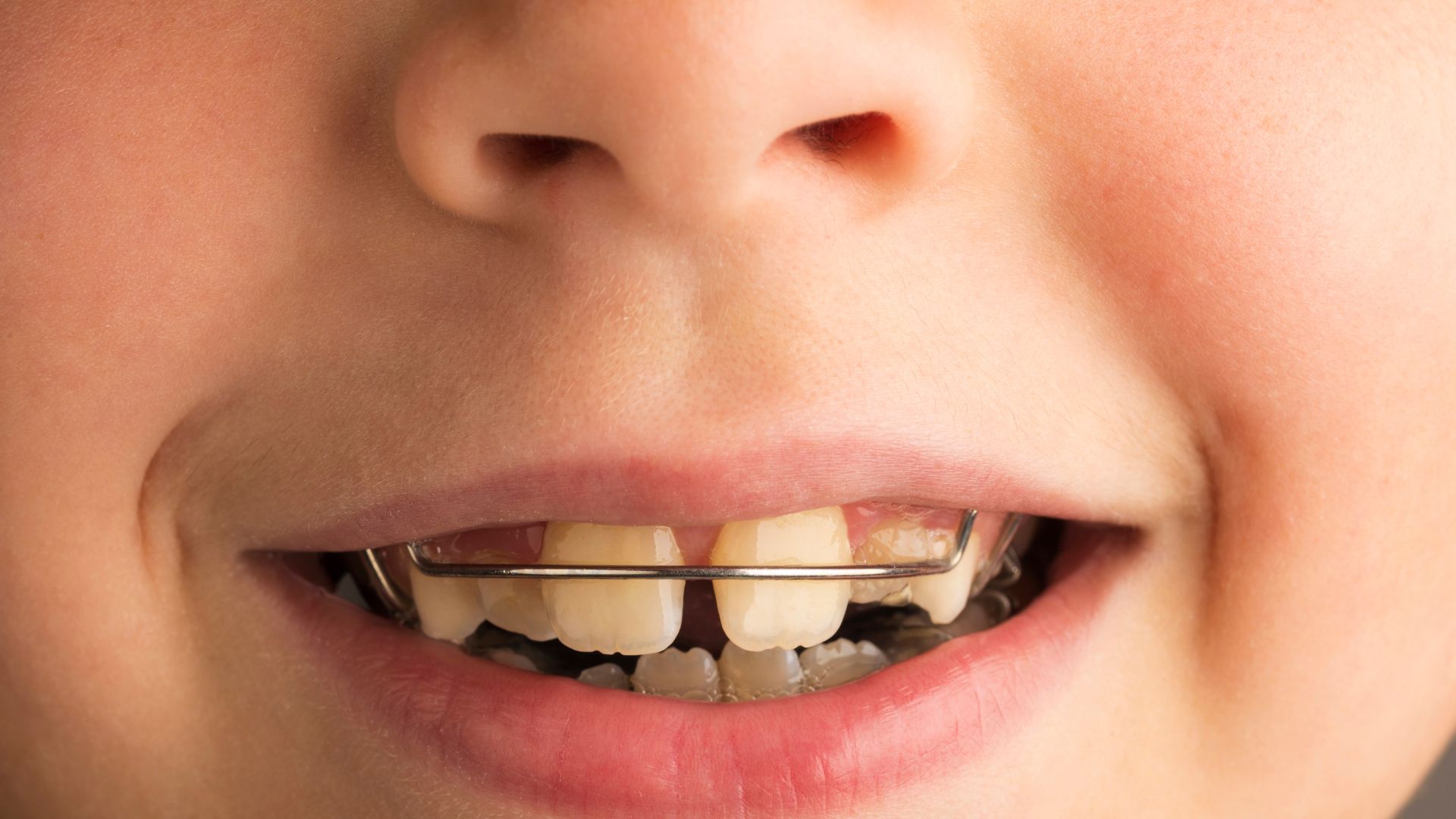 Qué es la Ortodoncia Interceptiva y por qué es clave la edad - BFEstéticaDental