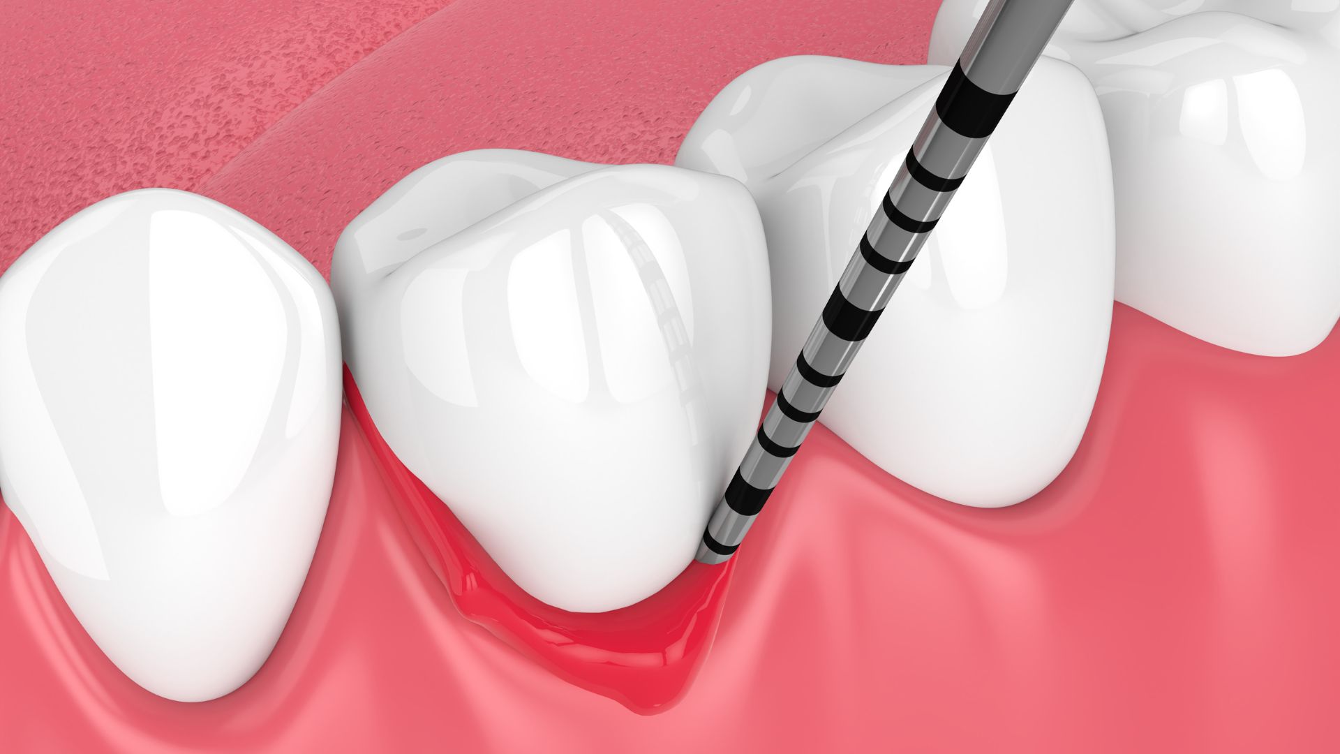 Periodoncia Avanzada - más allá de la limpieza - BF Estética Dental
